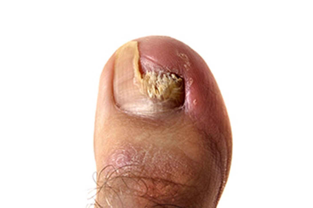 Types & Stages of Toenail Fungus | Premier Podiatry