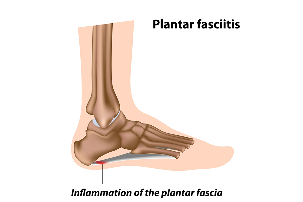 Plantar Fasciitis and Swimming