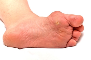 Differences Between Corns and Warts
